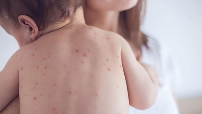 Попри збільшення хворих на кір, епідемії в Києві немає Попри збільшення хворих на кір, епідемії в Києві немає