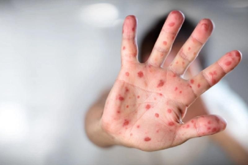 Скільки українців захворіли на кір з початку року: назвали цифру Скільки українців захворіли на кір з початку року: назвали цифру