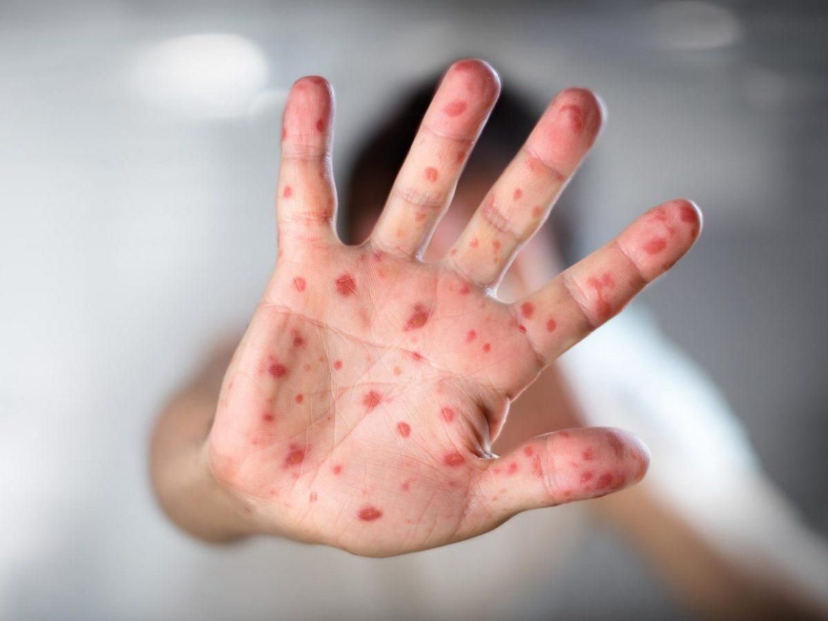 В Одесі зафіксували новий різновид кору В Одесі зафіксували новий різновид кору