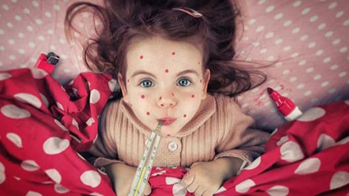 Корь в Харькове: в больницу попали 4 человека, которые имели прививки