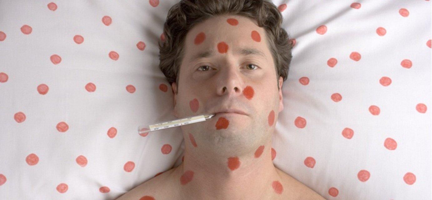 На Київщині зафіксували нові випадки кору серед військових На Київщині зафіксували нові випадки кору серед військових