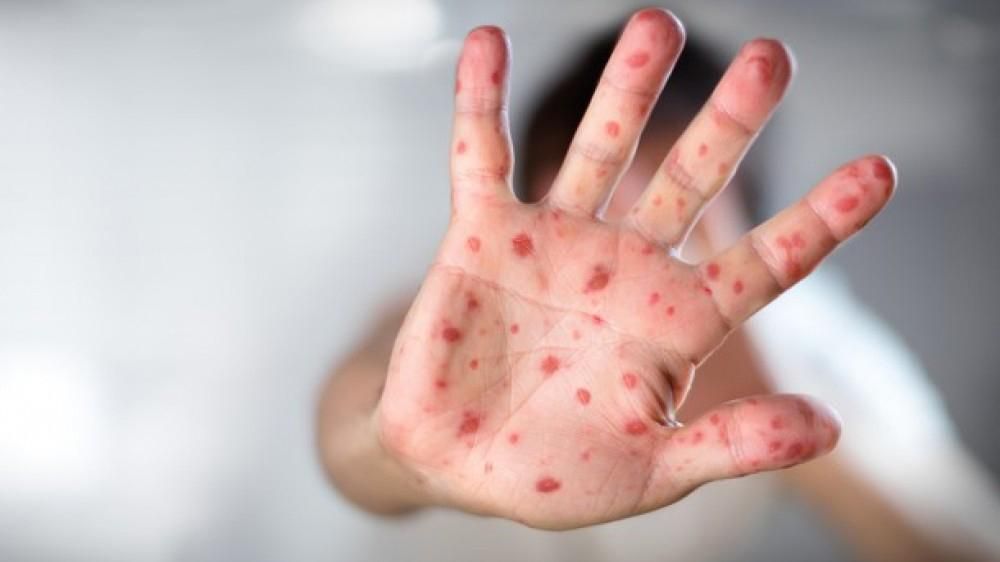 Майже 100 осіб на Закарпатті захворіли на кір за сім днів Майже 100 осіб на Закарпатті захворіли на кір за сім днів