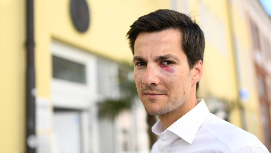 В Германии мэру города сломали нос во время празднования победы на выборах