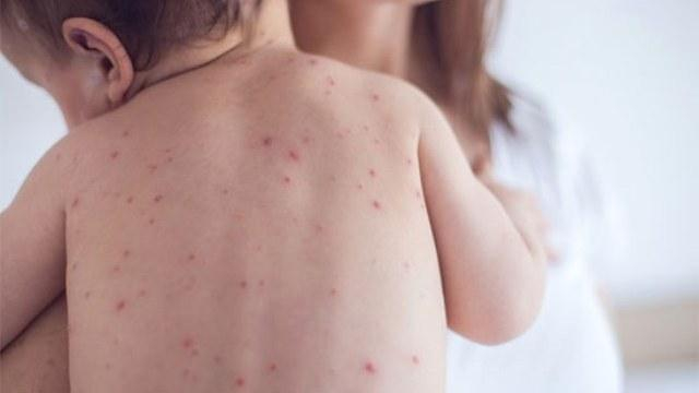 На Киевщине от кори умер маленький ребенок