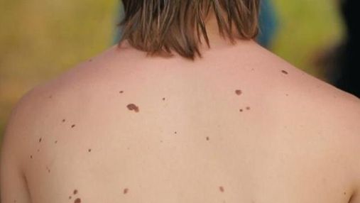 Вчені провели успішне випробування вакцини проти меланоми