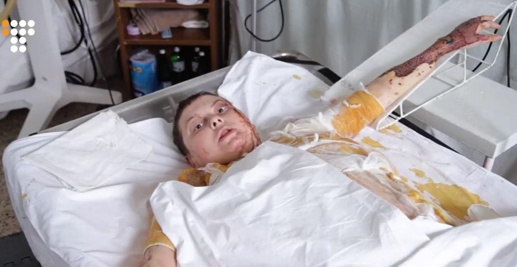 Как выглядит Екатерина Гандзюк, которую облили кислотой: видео Как выглядит Екатерина Гандзюк, которую облили кислотой: видео