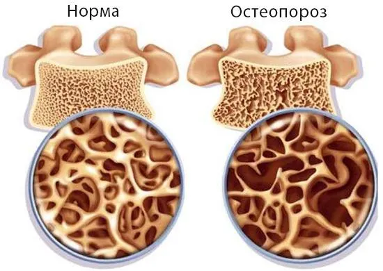 У яких випадках вітамін D не може запобігти розвитку остеопорозу