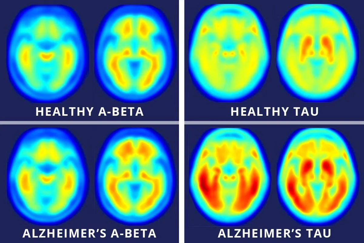 Концентрація амілоїдних та тау-білків в мозку, враженому хворобою Альцгеймера