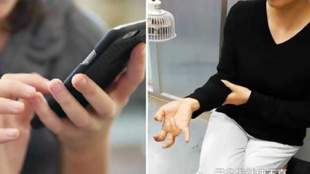 У дівчини виникли серйозні проблеми із рукою через тривале користування смартфоном 