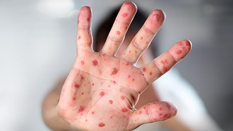 Спалах кору на Одещині: у селі Шевченкове оголосили карантин Спалах кору на Одещині: у селі Шевченкове оголосили карантин