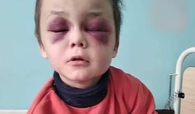 Замість очей – великі синці: на Вінниччині батьки жорстоко побили 6-річну дитину (оновлено)
