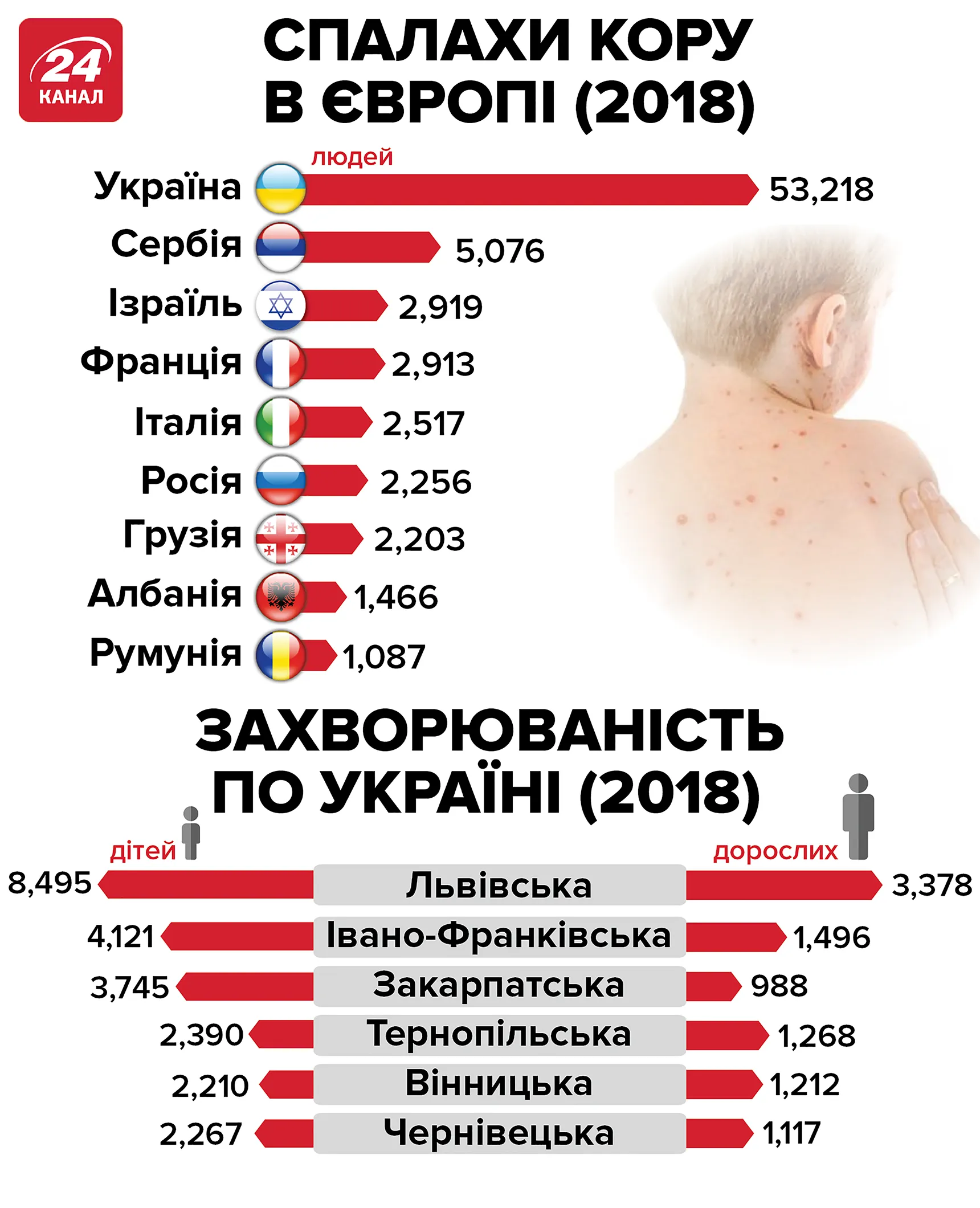 Эпидемия кори в Украине