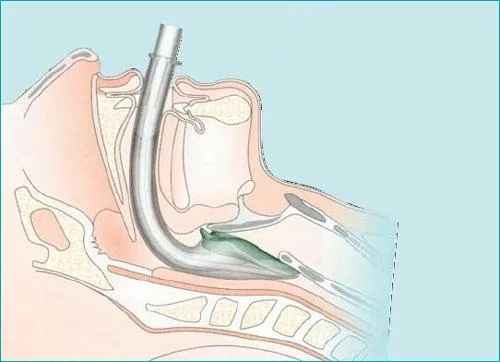 Ларингеальна маска Ларингеальна маска