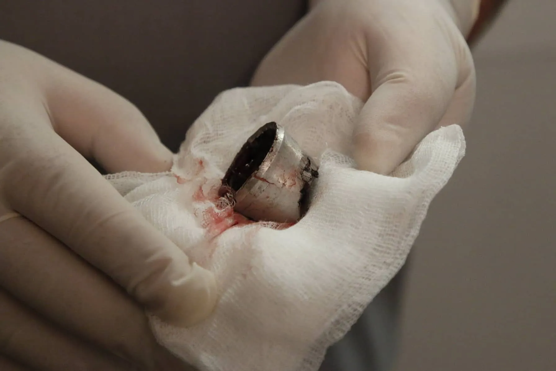 вибух діти операція постраждалі вибух діти операція постраждалі