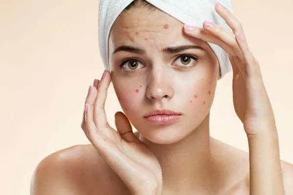 Лікування вугрів Лікування вугрів