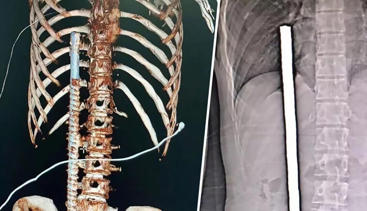 Китаєць вижив після падіння на арматуру, що проткнула все його тіло: фото 18+