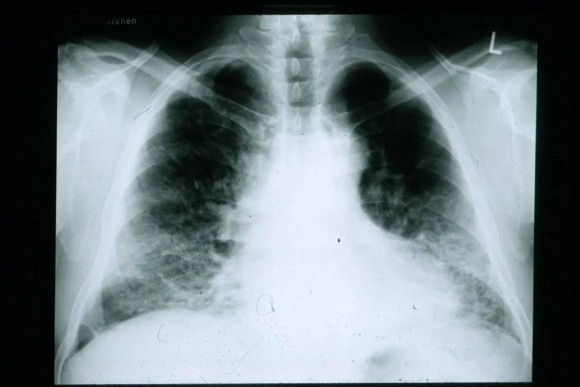 Фіброз легенів
