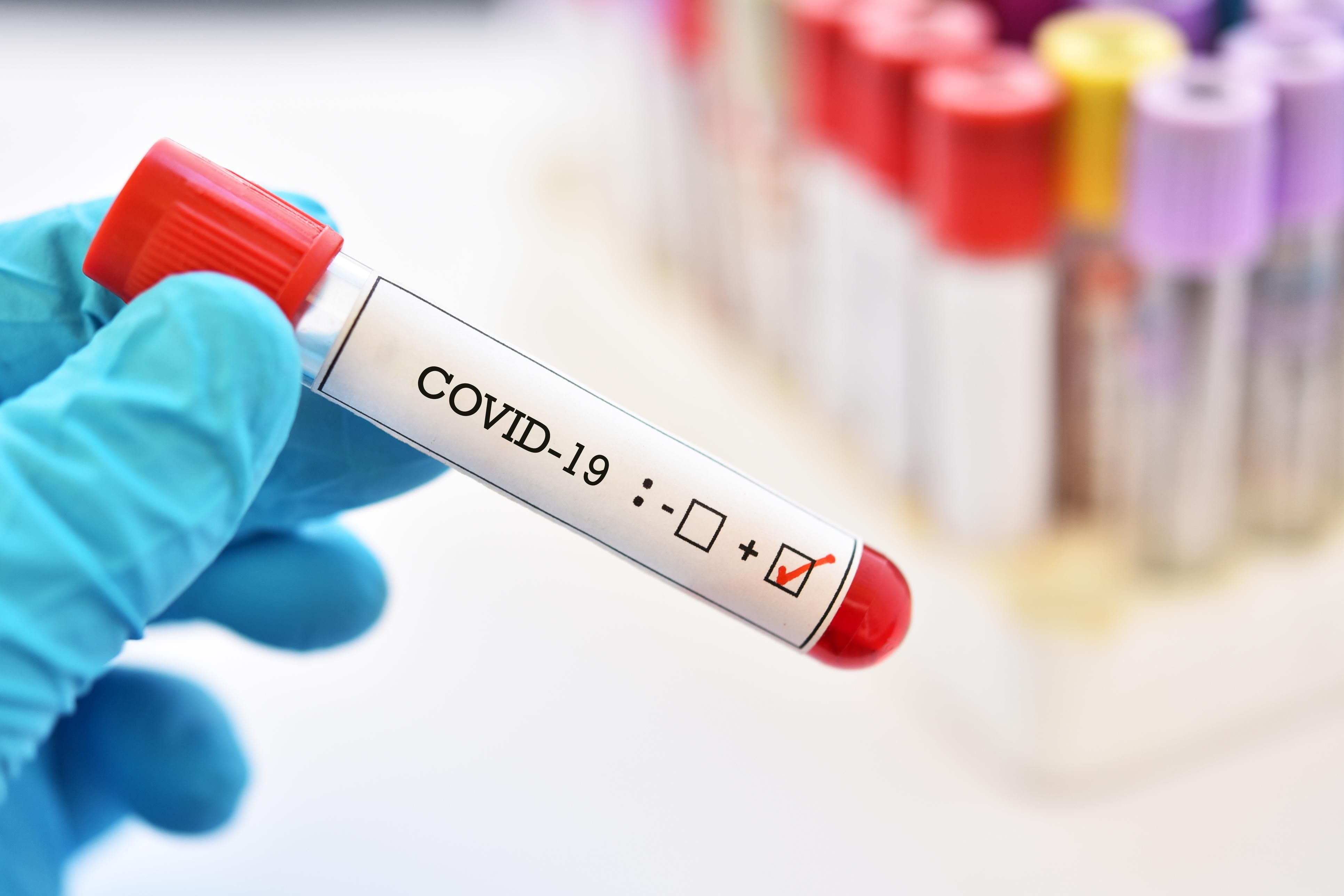 Тести на коронавірус в Україні: все що потрібно знати