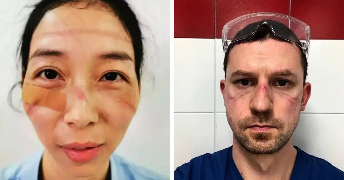 Сліди від масок у медиків Сліди від масок у медиків