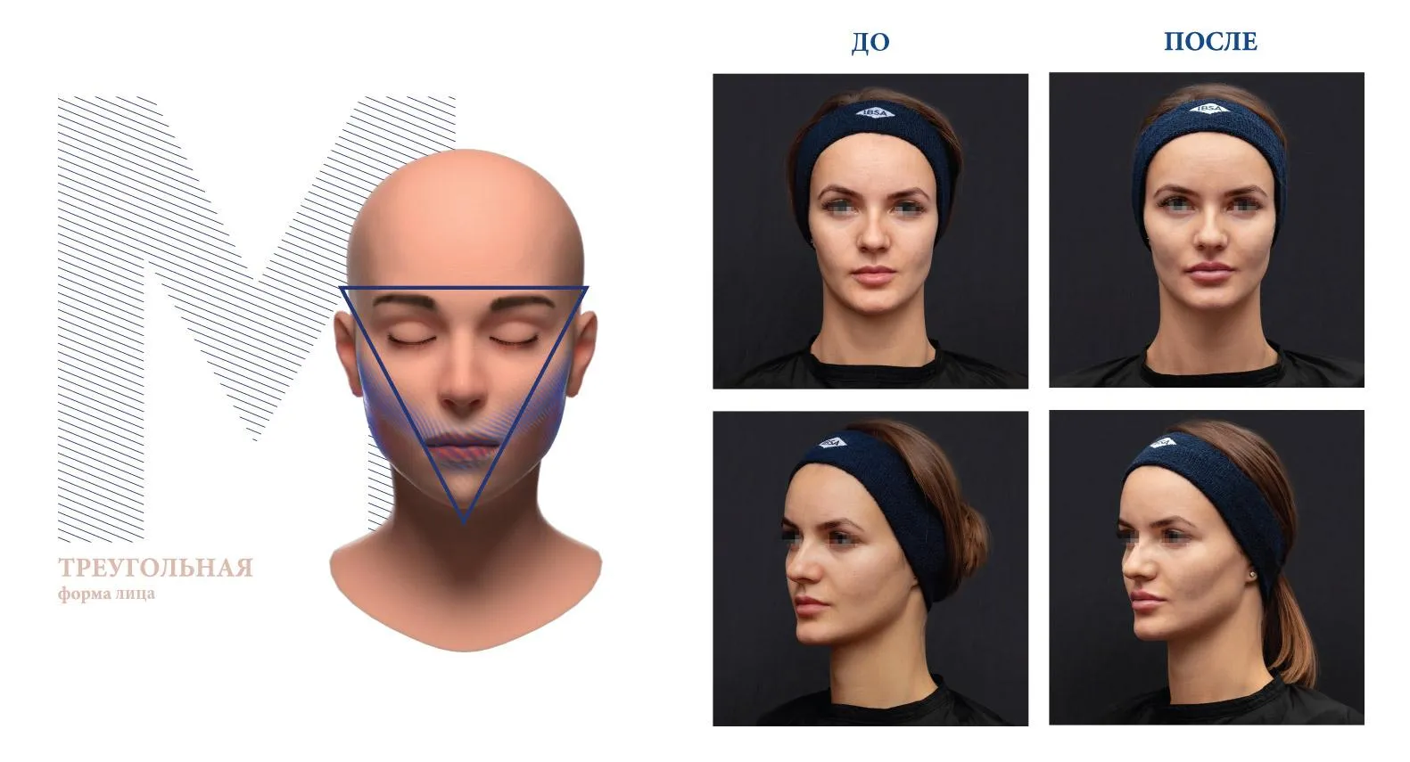 Процедура для корекції обличчя