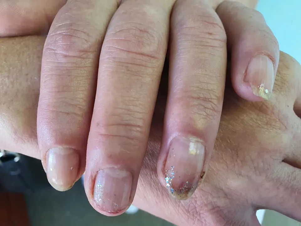 Потерпіла відбивалась, як могла. Проте травм уникнути не вдалося Потерпіла відбивалась, як могла. Проте травм уникнути не вдалося