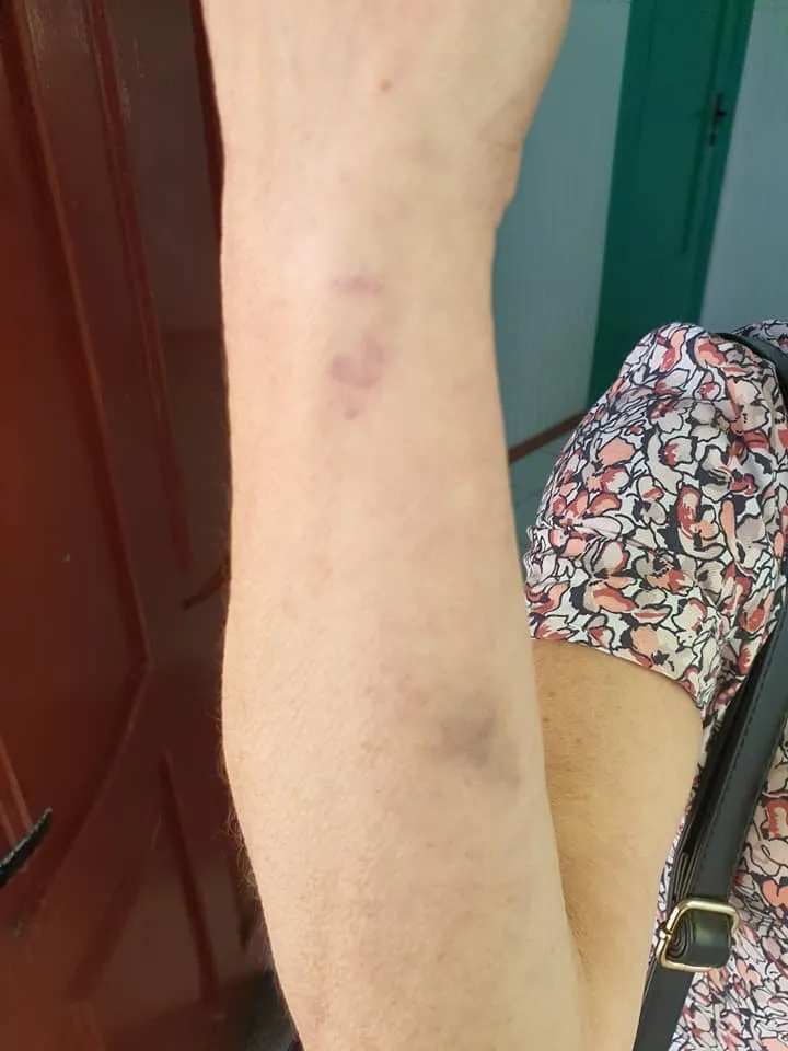 У Сумах побили кондукторку за прохання одягнути маску У Сумах побили кондукторку за прохання одягнути маску