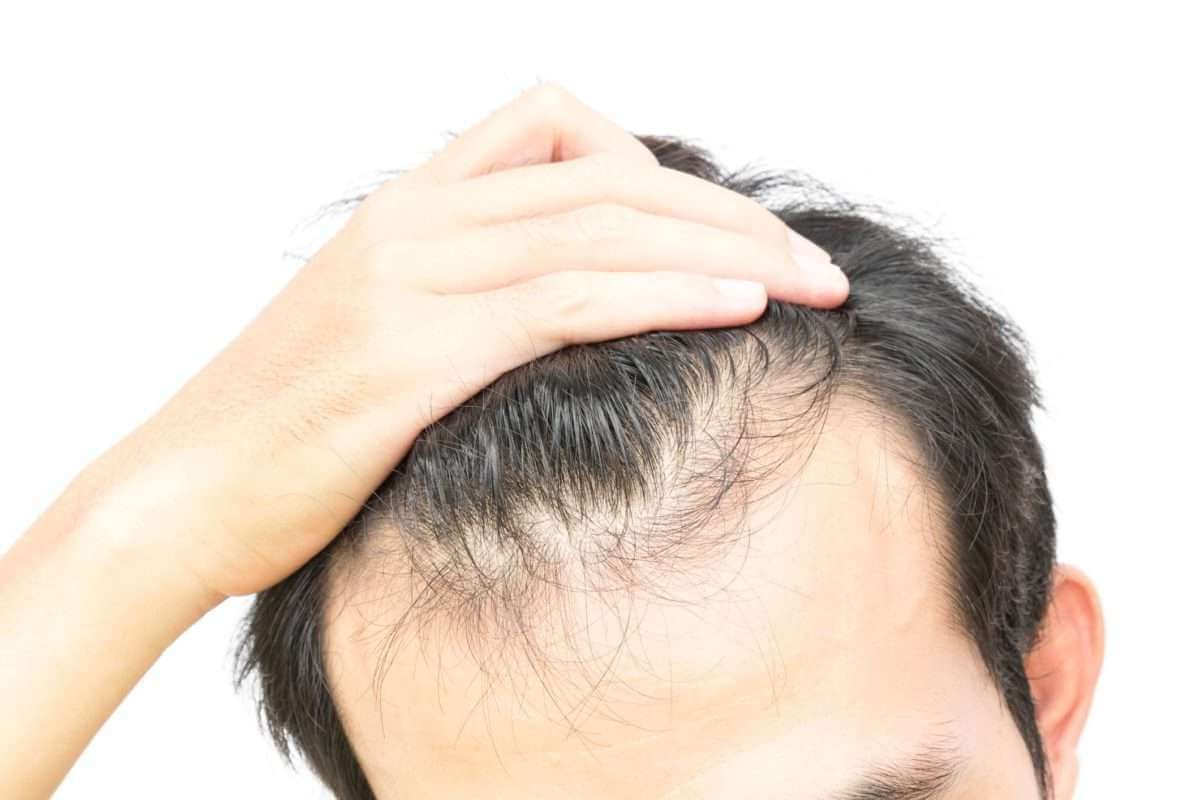 Почему выпадают волосы у мужчин: признаки, причины, лечение