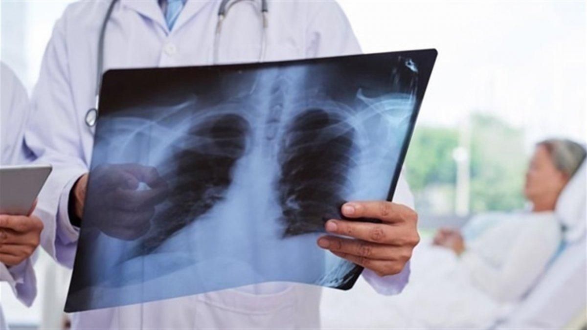 Туберкульоз, рак легенів і куріння, астма – міфи про хвороби легенів