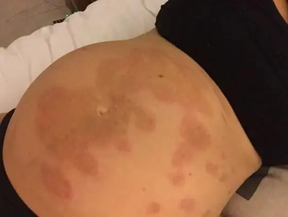 Приклад хлоазми / Фото nataleec2 Buzzfeed Приклад хлоазми / Фото nataleec2 Buzzfeed