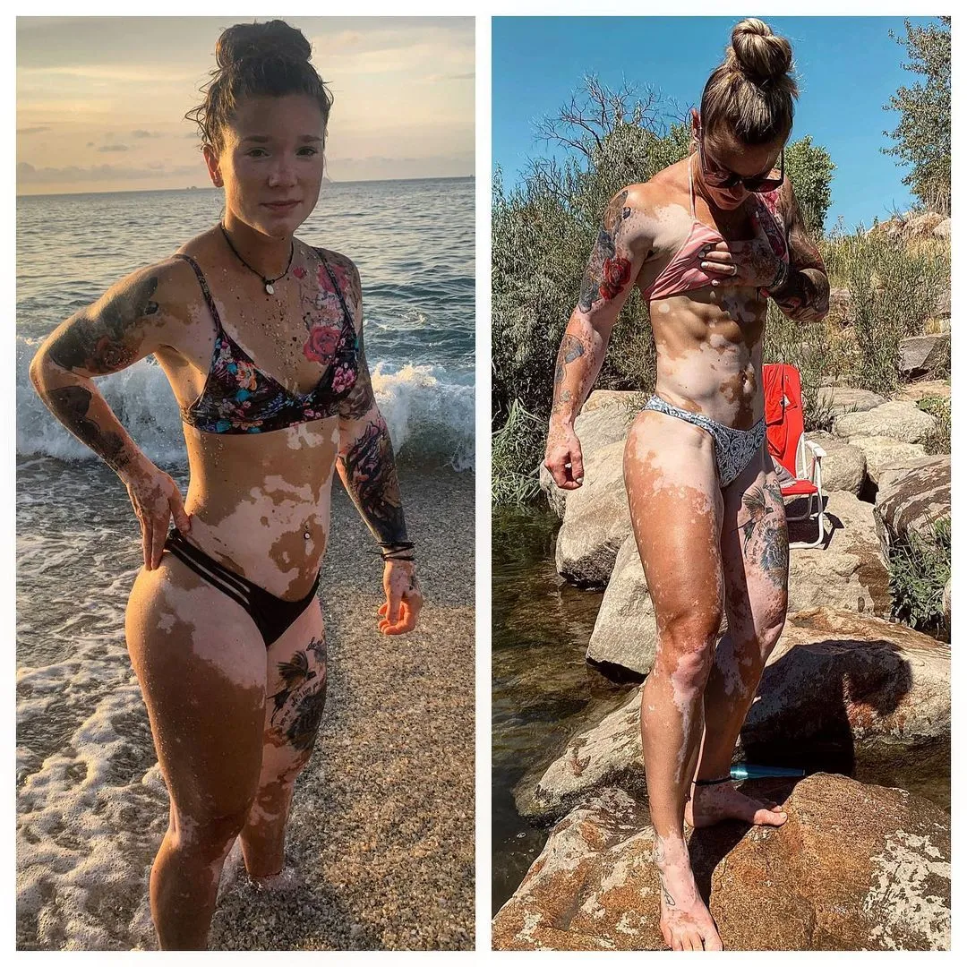 Світлі плями на тілі Антонії Ліверс - це прояви вітіліго / Фото toni_dino Світлі плями на тілі Антонії Ліверс - це прояви вітіліго / Фото toni_dino