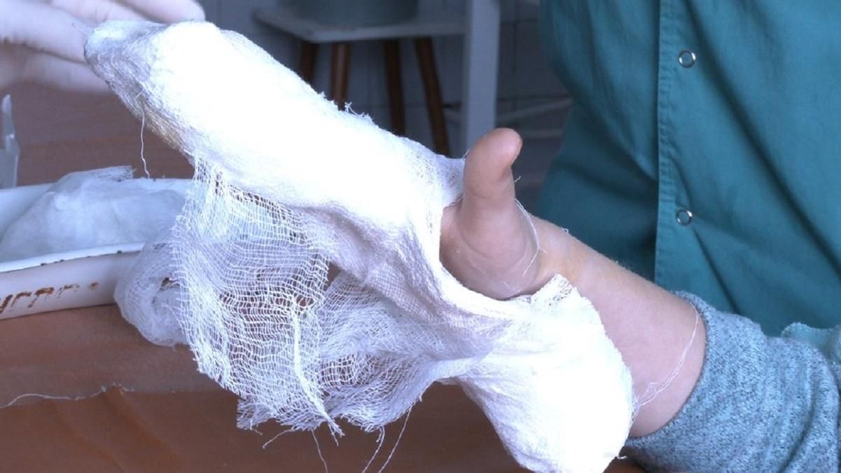 У Харкові школярка отримала перелом пальців: що каже мама У Харкові школярка отримала перелом пальців: що каже мама