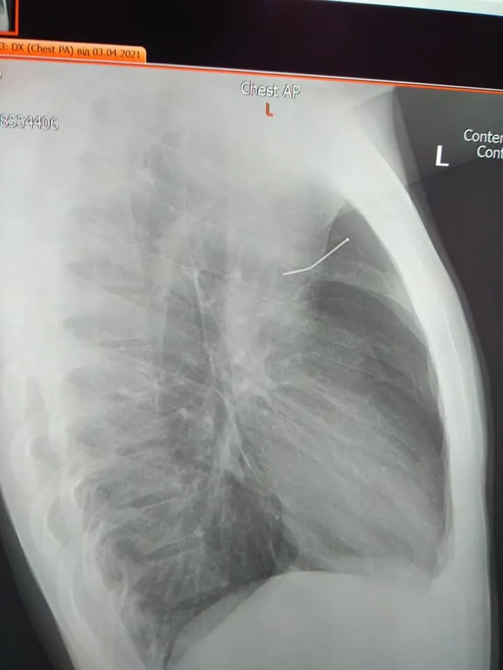 Вистрілив собі цвяхом у груди: львівські лікарі врятували 17-річного хлопця – фото