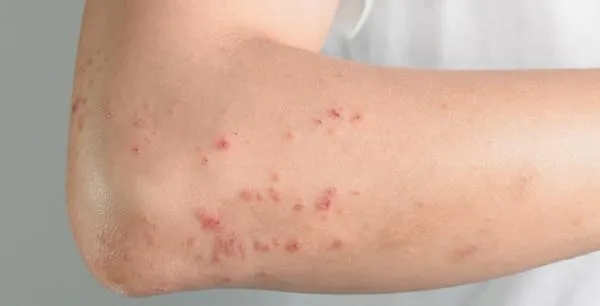 Позбавитися від свербіжу Позбавитися від свербіжу