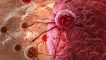 Вчені знайшли механізм, який може допомогти зупинити поширенню ракових клітин пухлини