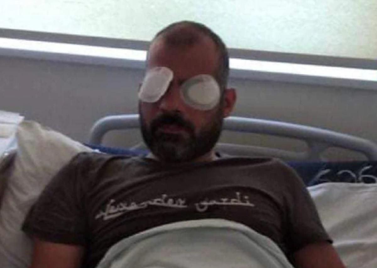 У Грузії на одне око осліп оператор, якого побили противники ЛГБТ
