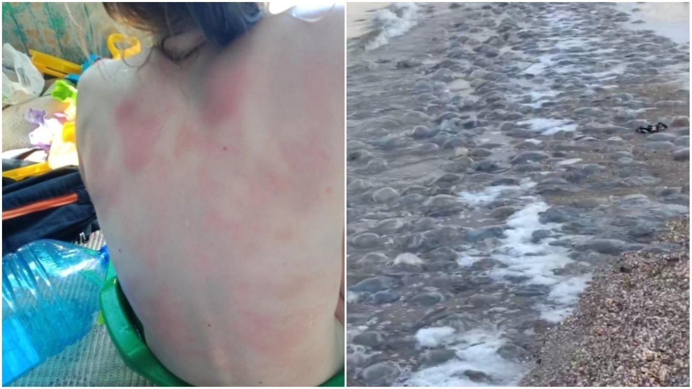 Медузы в Кирилловке 2021: у ребенка страшная аллергия – фото видео
