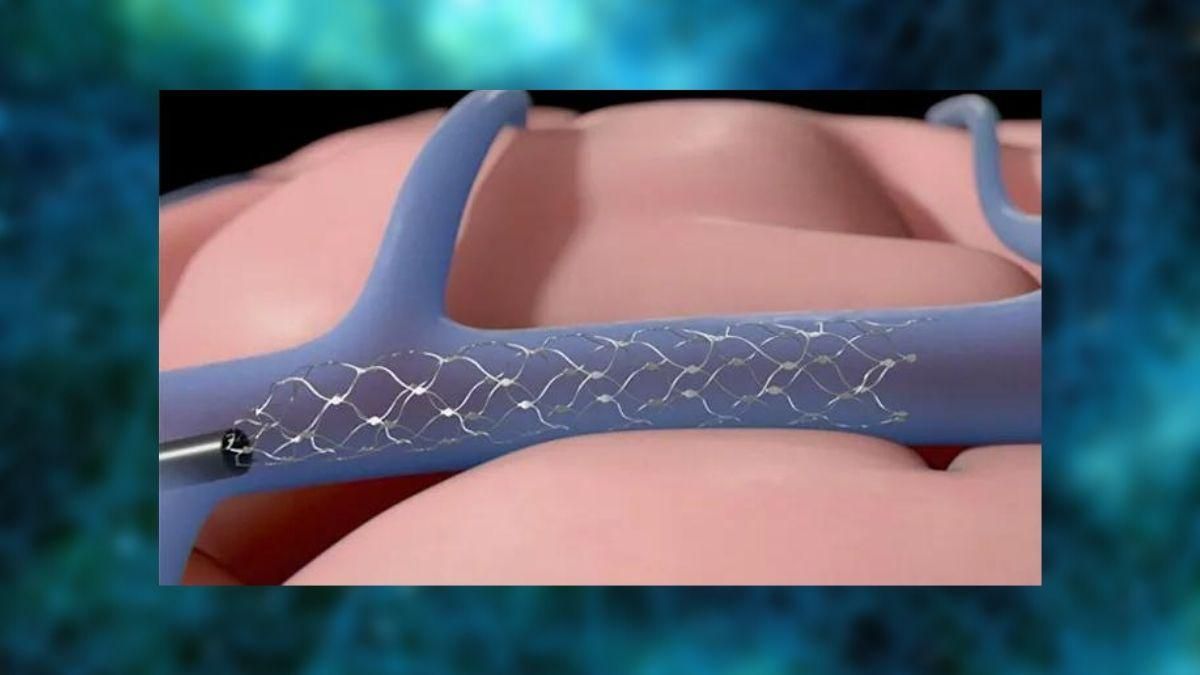 FDA схвалило випробування нейроімплантів на людях FDA схвалило випробування нейроімплантів на людях