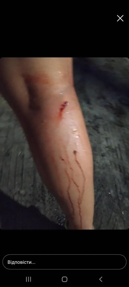 напад собаки на жінку у Києві напад собаки на жінку у Києві