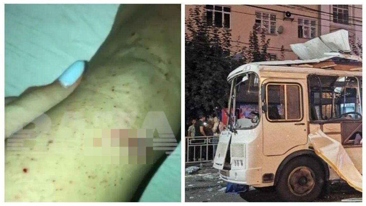 Вибух у Воронежі: постраждалі скаржаться на металеву стружку на шкірі