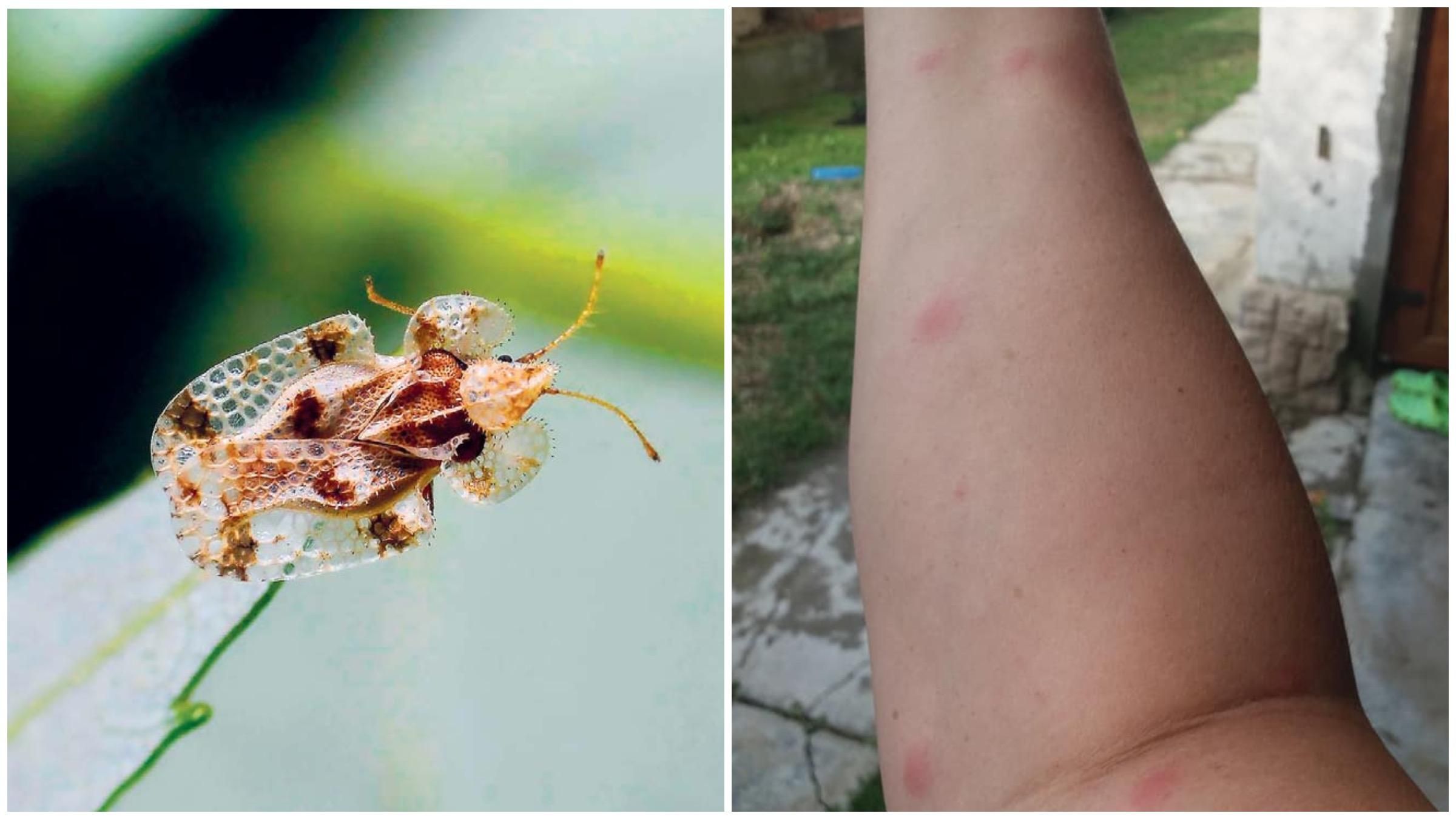 Все тіло в червоних плямах: на Закарпатті людей "атакують" кусючі клопи - Україна новини - 24 Канал Все тіло в червоних плямах: на Закарпатті людей "атакують" кусючі клопи - Україна новини - 24 Канал