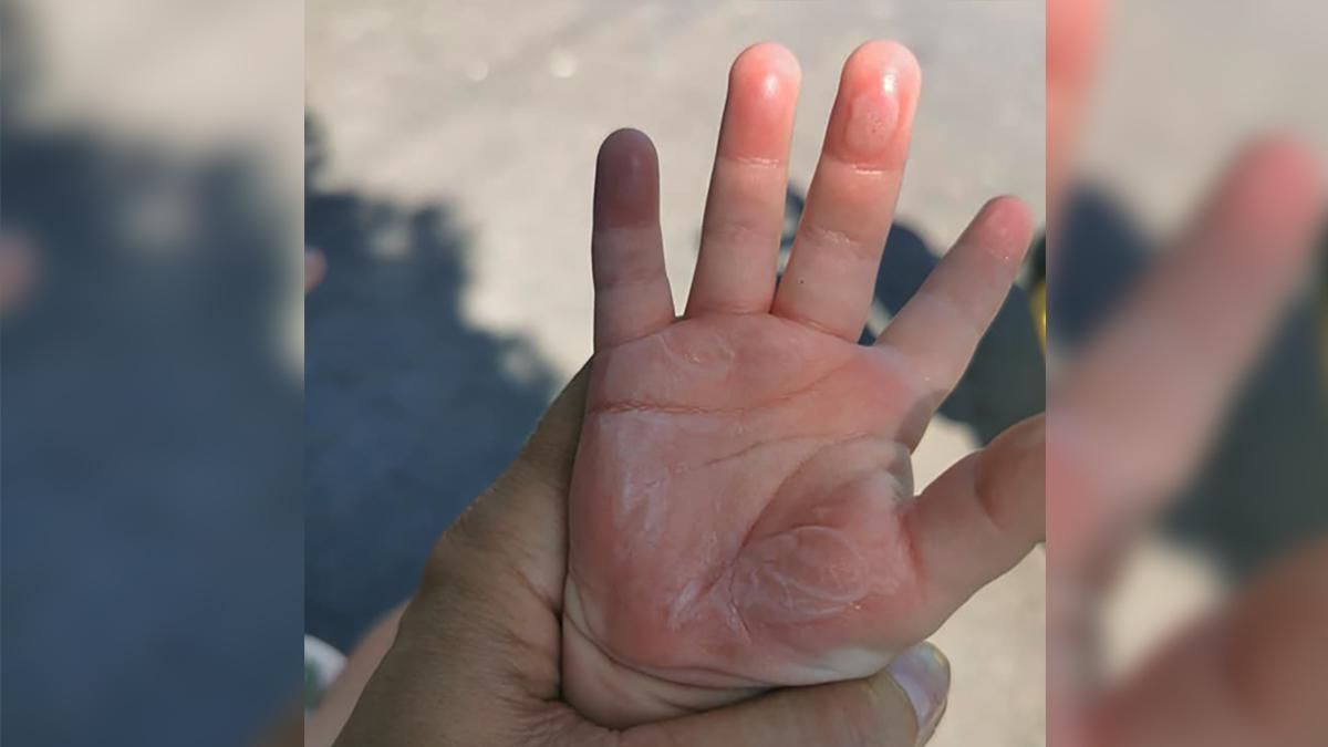 Малюк обпікся об пам'ятник в центрі Одеси: знадобилася швидка – фото пошкоджень - Україна новини - 24 Канал Малюк обпікся об пам'ятник в центрі Одеси: знадобилася швидка – фото пошкоджень - Україна новини - 24 Канал