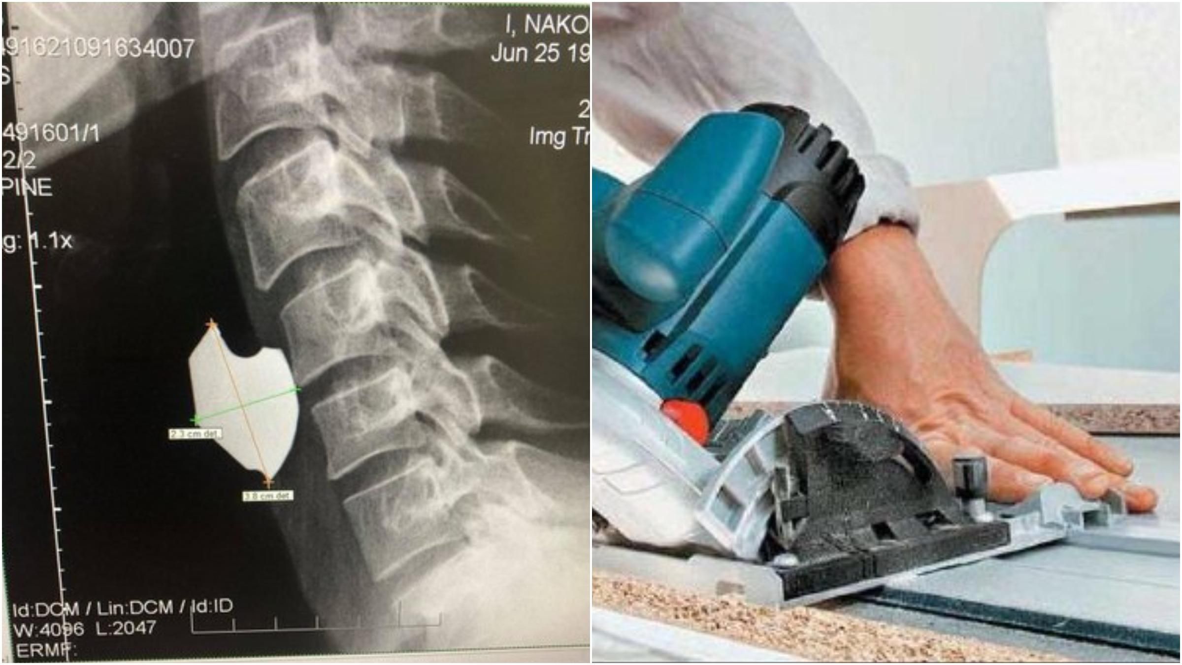 Біля сонної артерії: у Тернополі врятували чоловіка з уламком пили у шиї - Новини Тернопіль - 24 Канал Біля сонної артерії: у Тернополі врятували чоловіка з уламком пили у шиї - Новини Тернопіль - 24 Канал