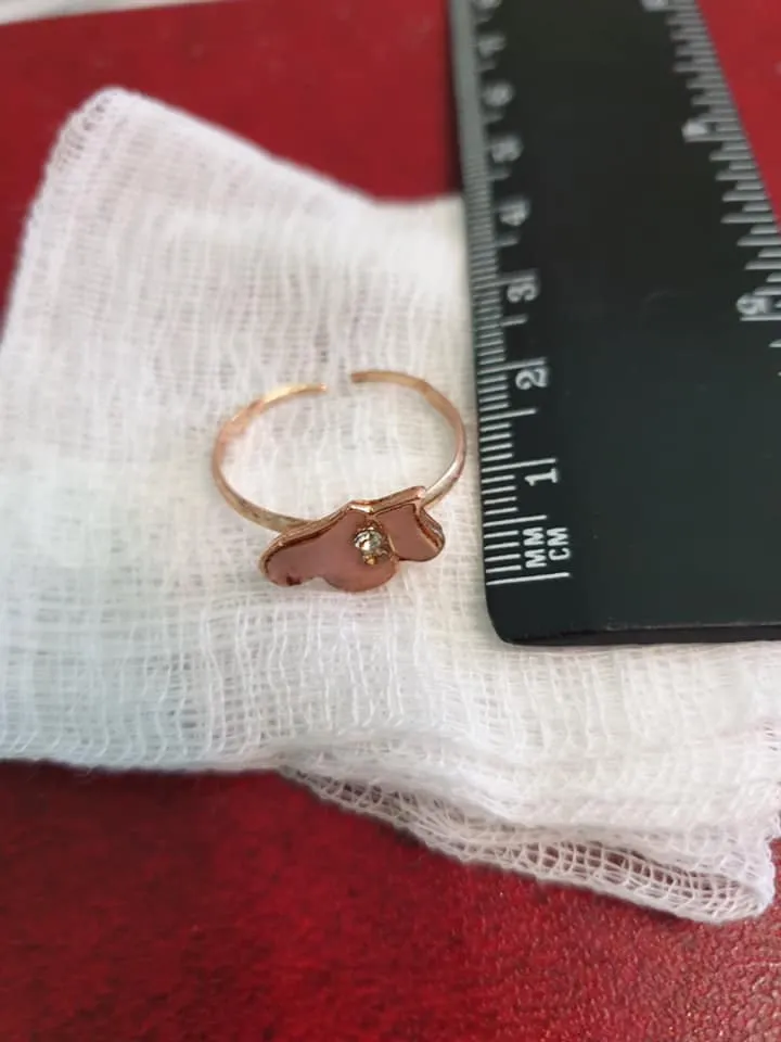 Однорічна дівчинка проковтнула перстень з гострими краями: львівські лікарі врятували малечу