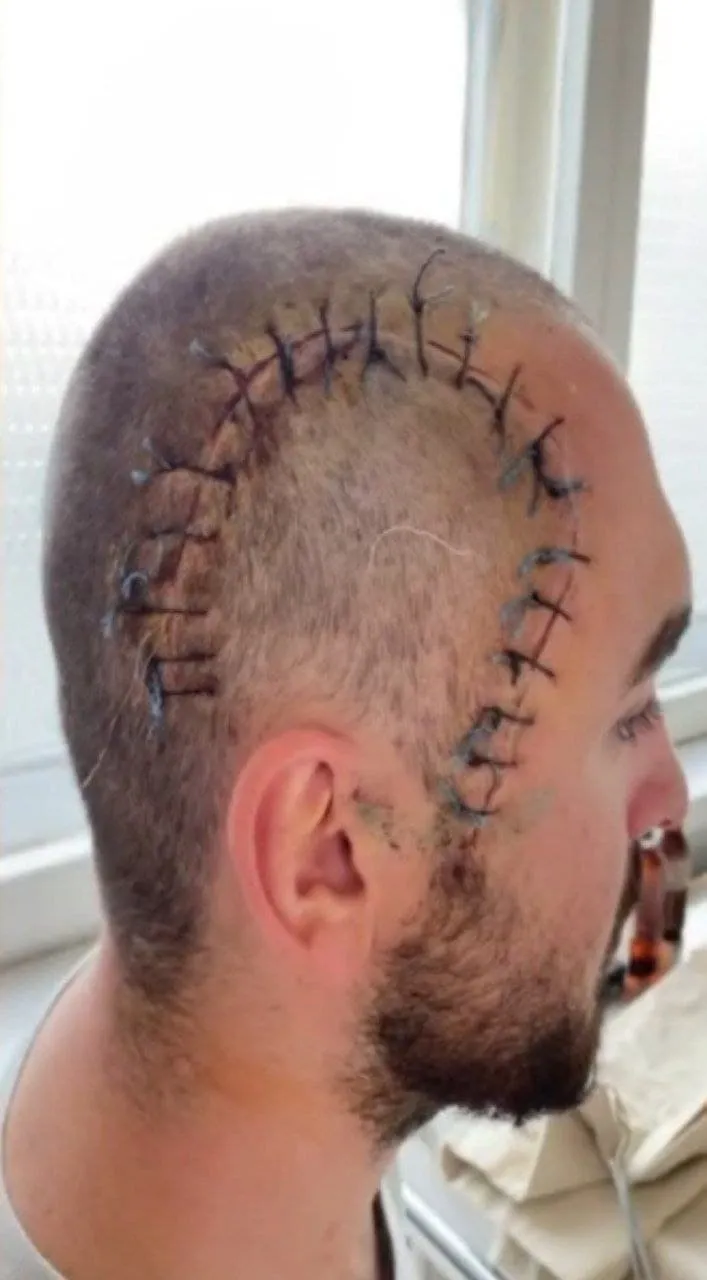 Блогер Олексій Остаповський пережив трепанацію, його побили біля караоке у Києві Блогер Олексій Остаповський пережив трепанацію, його побили біля караоке у Києві