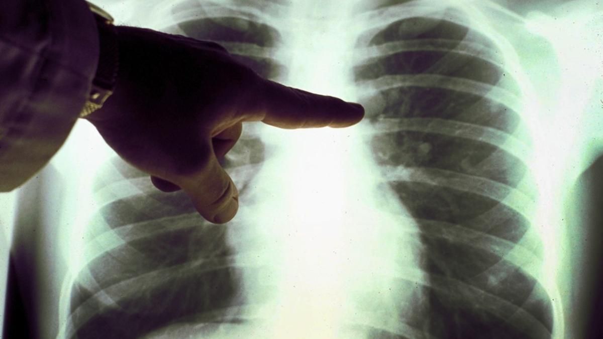 "Еще даже не конец месяца": жуткая статистика смертности от пневмонии во Львове