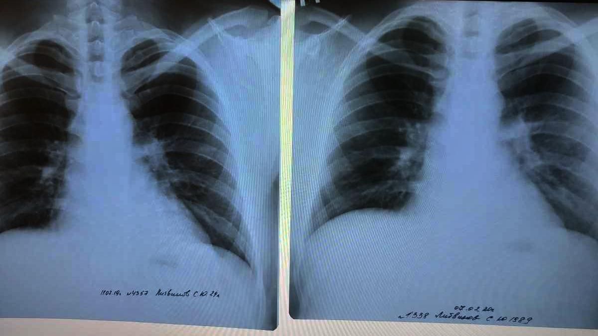 Померла 5-річна дівчинка з Одещини: мала пневмонію невідомого походження - Україна новини - 24 Канал Померла 5-річна дівчинка з Одещини: мала пневмонію невідомого походження - Україна новини - 24 Канал