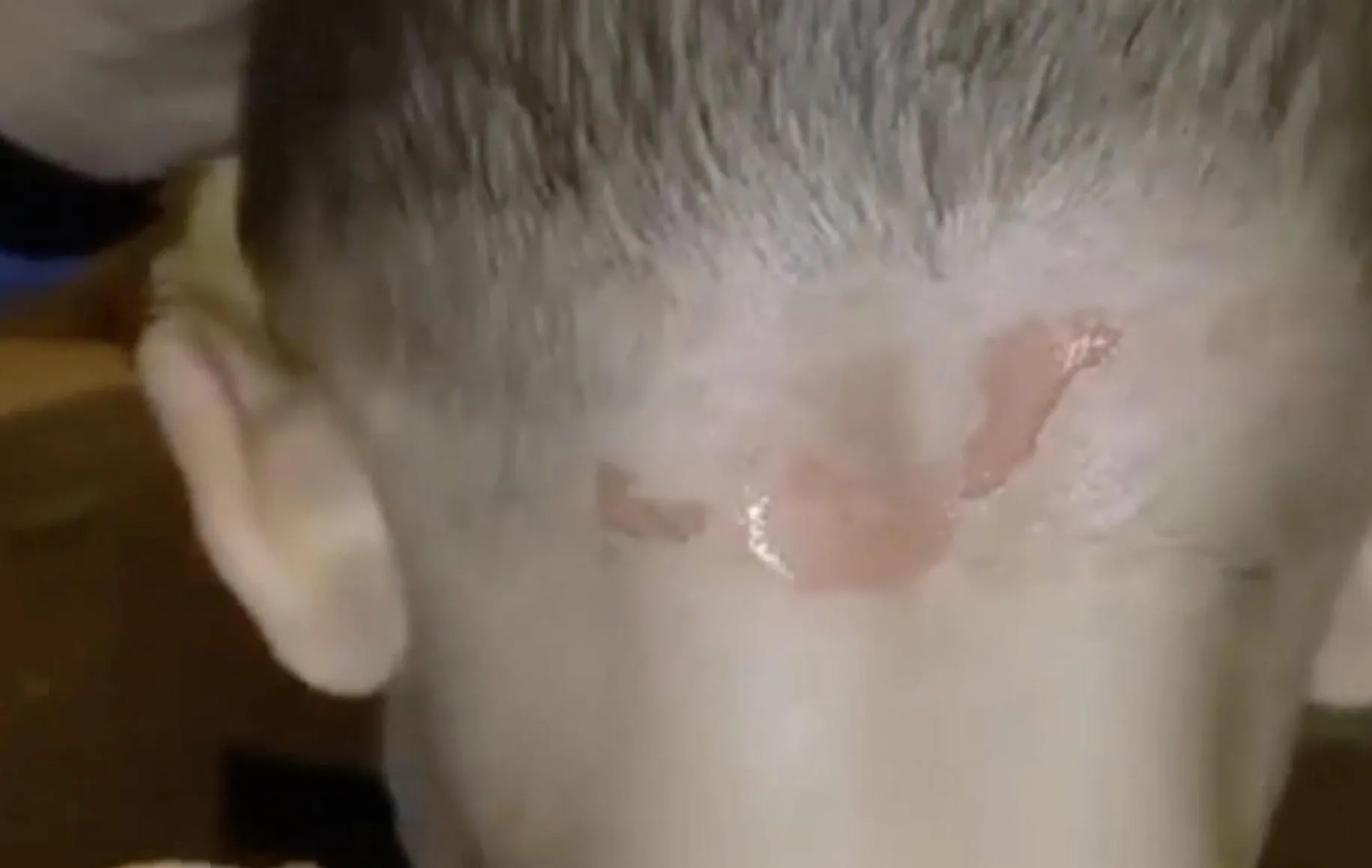 Опіки Опіки