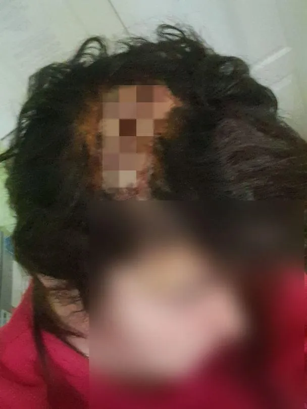 У Києві біля школи на жінку впала гілка, їй зашивали голову У Києві біля школи на жінку впала гілка, їй зашивали голову