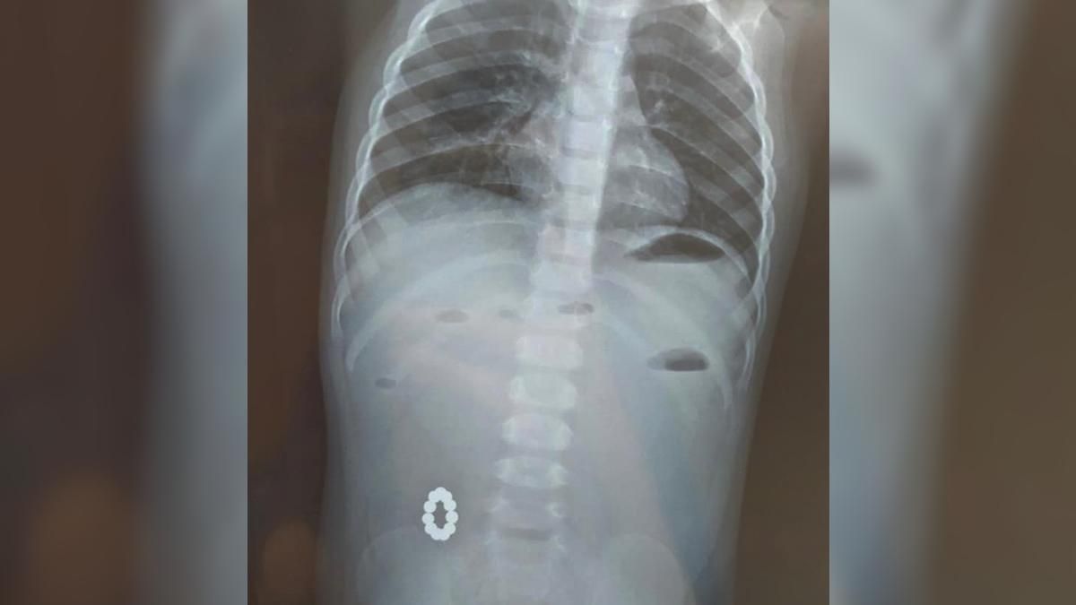 У Харкові немовля проковтнуло кілька магнітів і опинилося на операційному столі - Новини Харкова - Харків У Харкові немовля проковтнуло кілька магнітів і опинилося на операційному столі - Новини Харкова - Харків