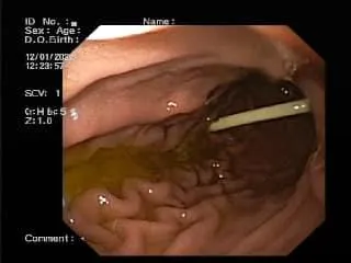 У Дніпрі дитина з'їла паличку Chupa Chups У Дніпрі дитина з'їла паличку Chupa Chups